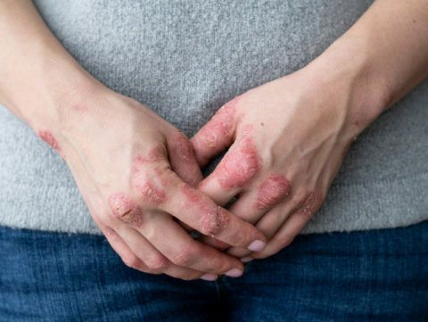 Dermatitis atópica: hábitos alterados