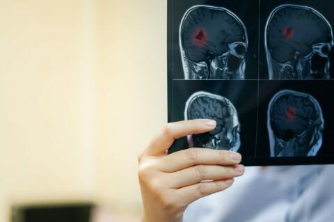 Formas clínicas en las que puede presentarse o evolucionar la esclerosis múltiple