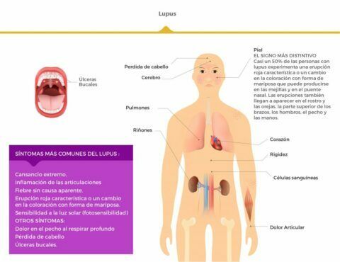 Nueve de cada diez pacientes con lupus son mujeres