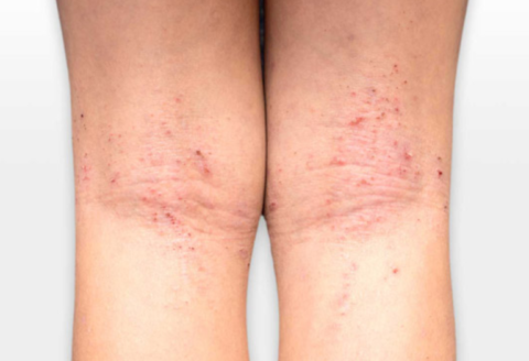 ¿Qué es la dermatitis atópica?
