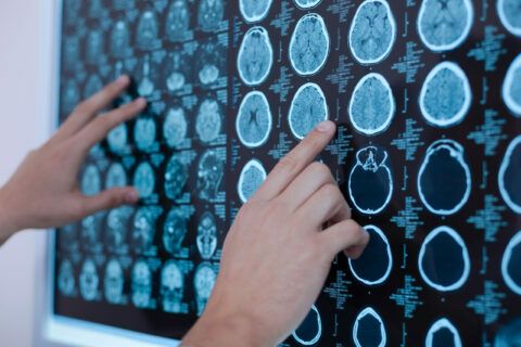 Acromegalia: la detección puede demorar cinco años