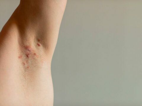 Hidradenitis supurativa: mucho más que una enfermedad de la piel