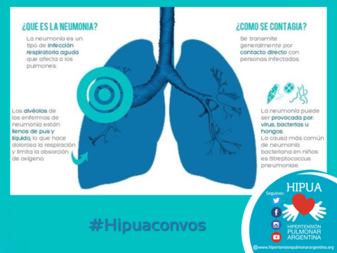 ¿Qué es la neumonía? ¿Cuáles son sus síntomas? ¿Cómo se puede prevenir?