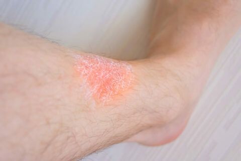 Psoriasis: 10 consejos para mejorar la calidad de vida