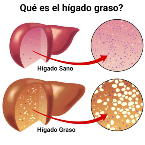 ¿La enfermedad del hígado graso puede aparecer asociada a la Hipertensión Pulmonar?