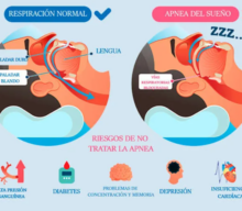 La apnea del sueño y su relación con la Hipertensión Pulmonar