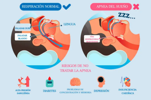 La apnea del sueño y su relación con la Hipertensión Pulmonar