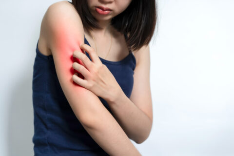 ¿Qué es la NEURODERMATITIS?