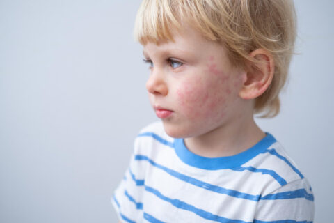14 de septiembre – Día Mundial de la Dermatitis Atópica